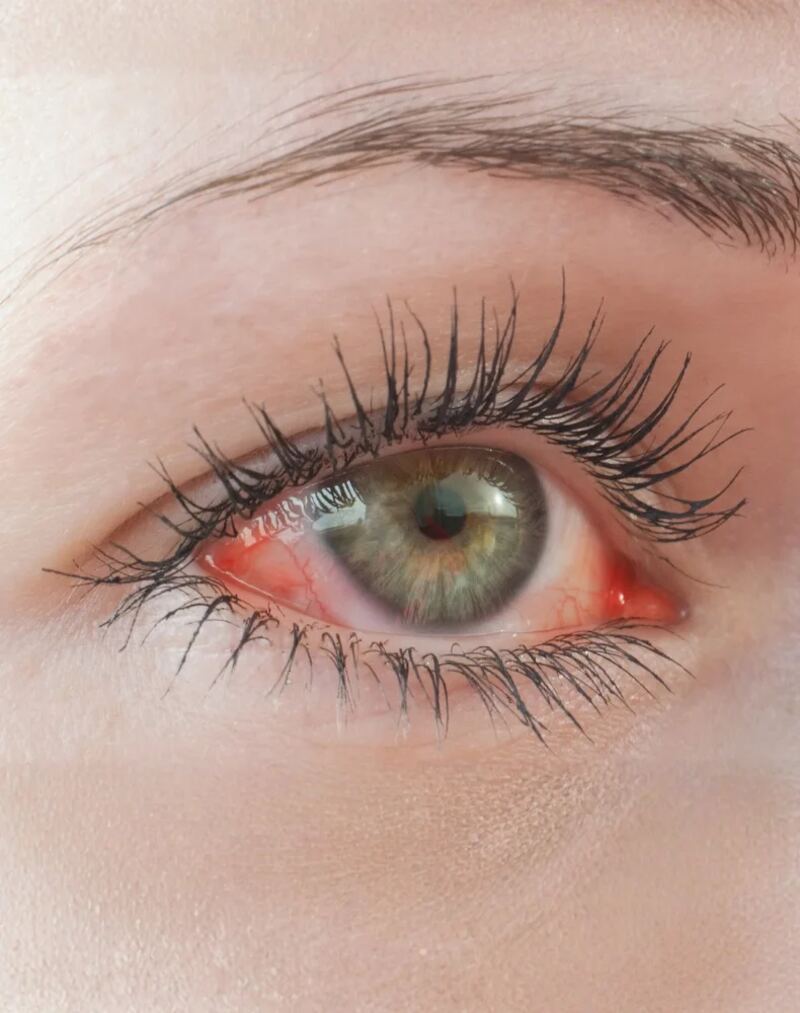 Red Eye Visits
