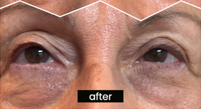 After OptiLIFT — patient 1