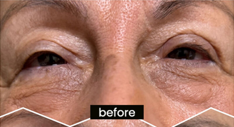 Before OptiLIFT — patient 1