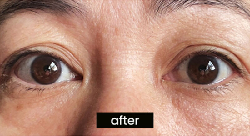 After OptiLIFT — patient 2