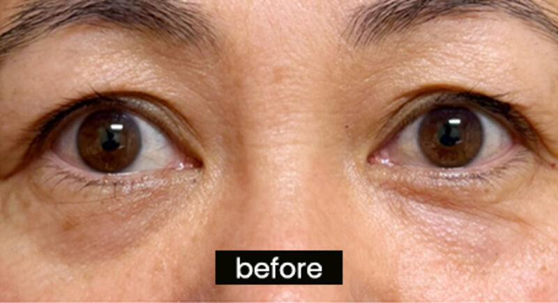Before OptiLIFT — patient 2