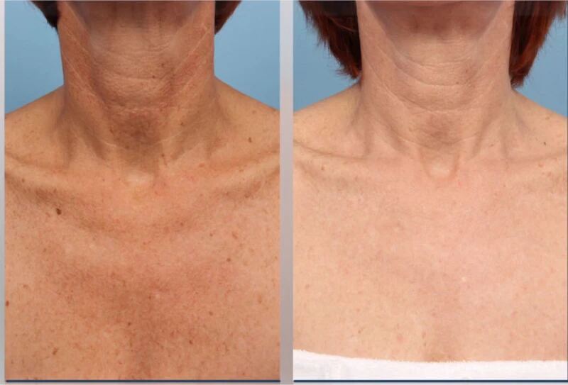 Lumenis IPL before and after — Face