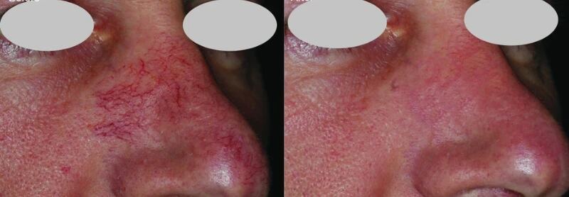 Lumenis IPL before and after — Rosacea