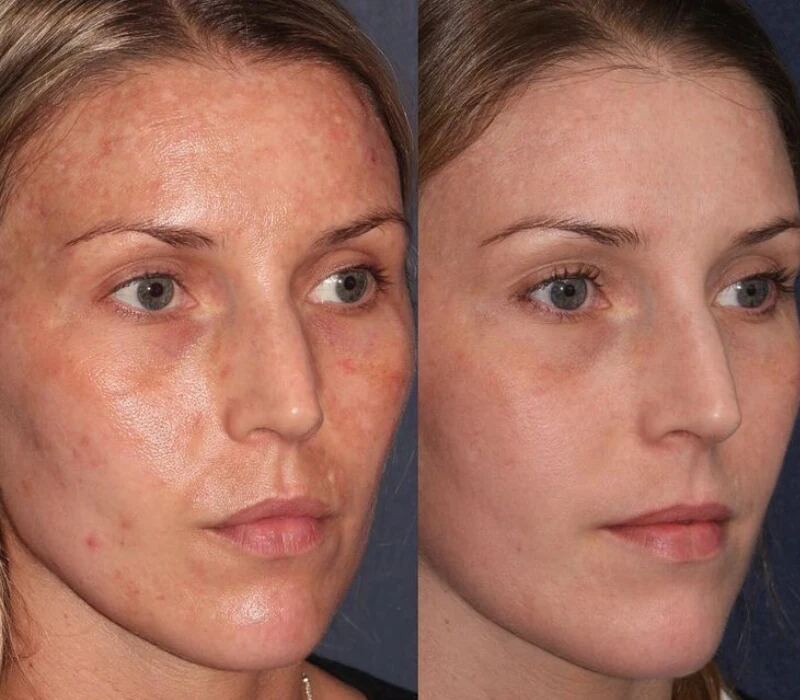 Lumenis IPL before and after — Acne