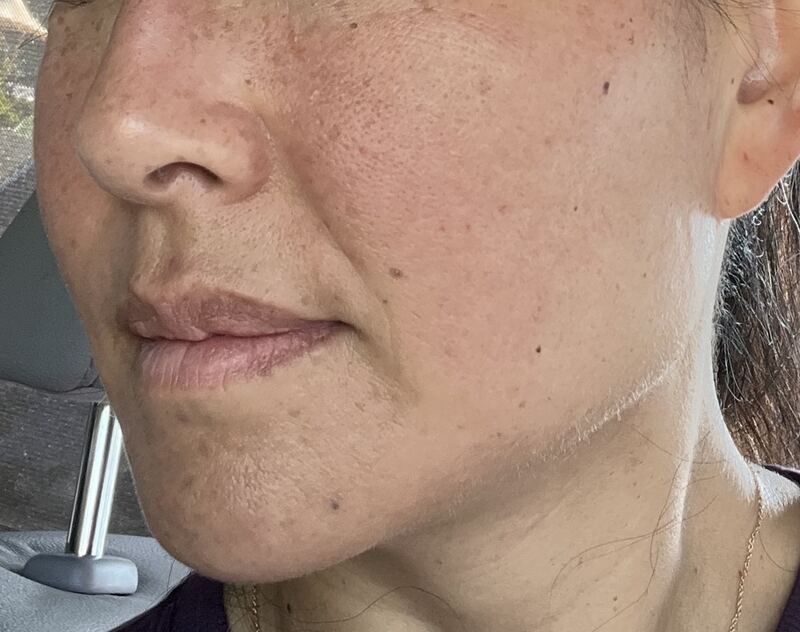 After Lumenis IPL treatment — facial skin