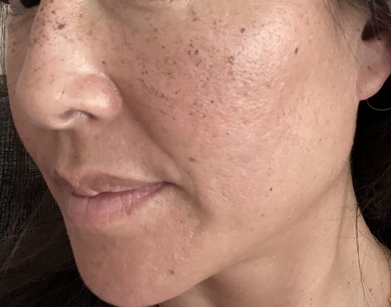 Before Lumenis IPL treatment — facial skin
