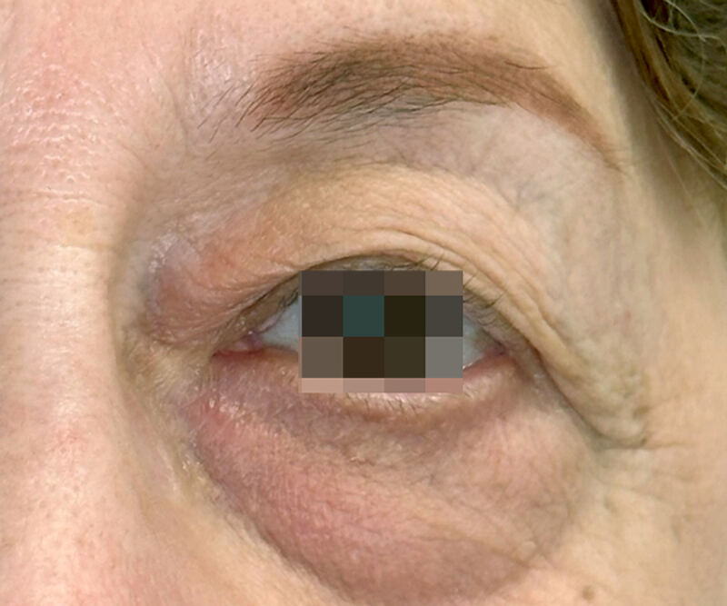 OptiLIFT before treatment — case 1