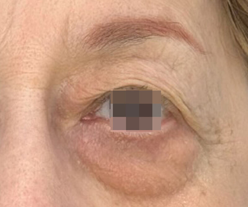 OptiLIFT after treatment — case 1