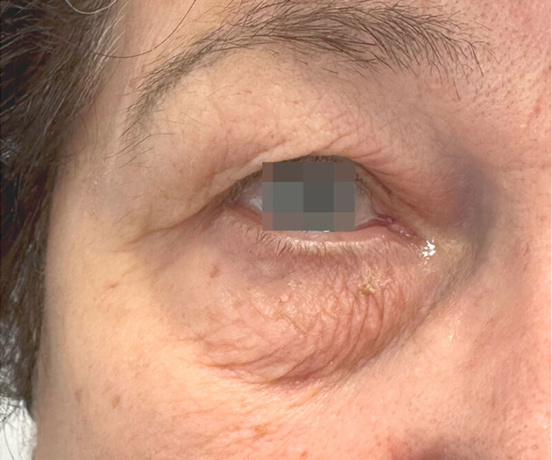 OptiLIFT before treatment — case 2