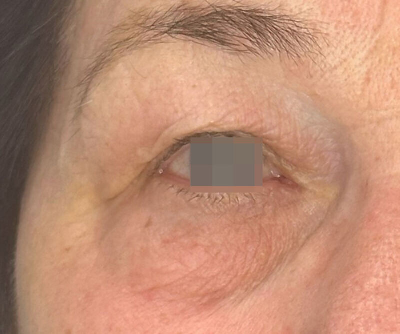 OptiLIFT after treatment — case 2