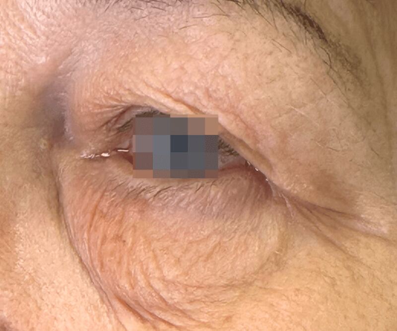 OptiLIFT before treatment — case 3