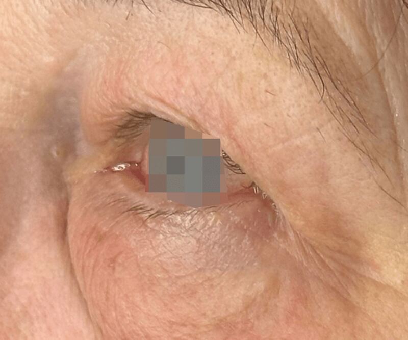 OptiLIFT after treatment — case 3
