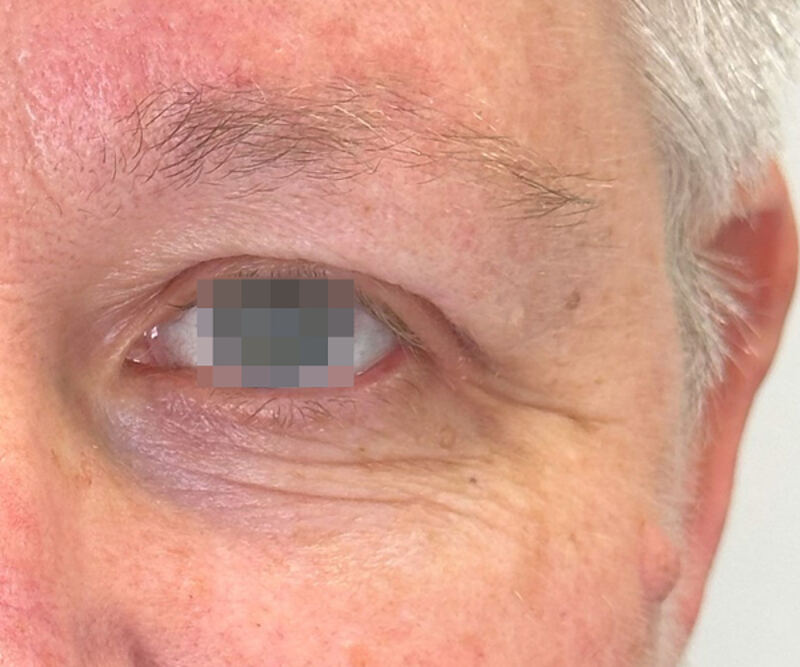 OptiLIFT before treatment — case 4