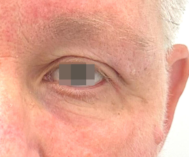 OptiLIFT after treatment — case 4