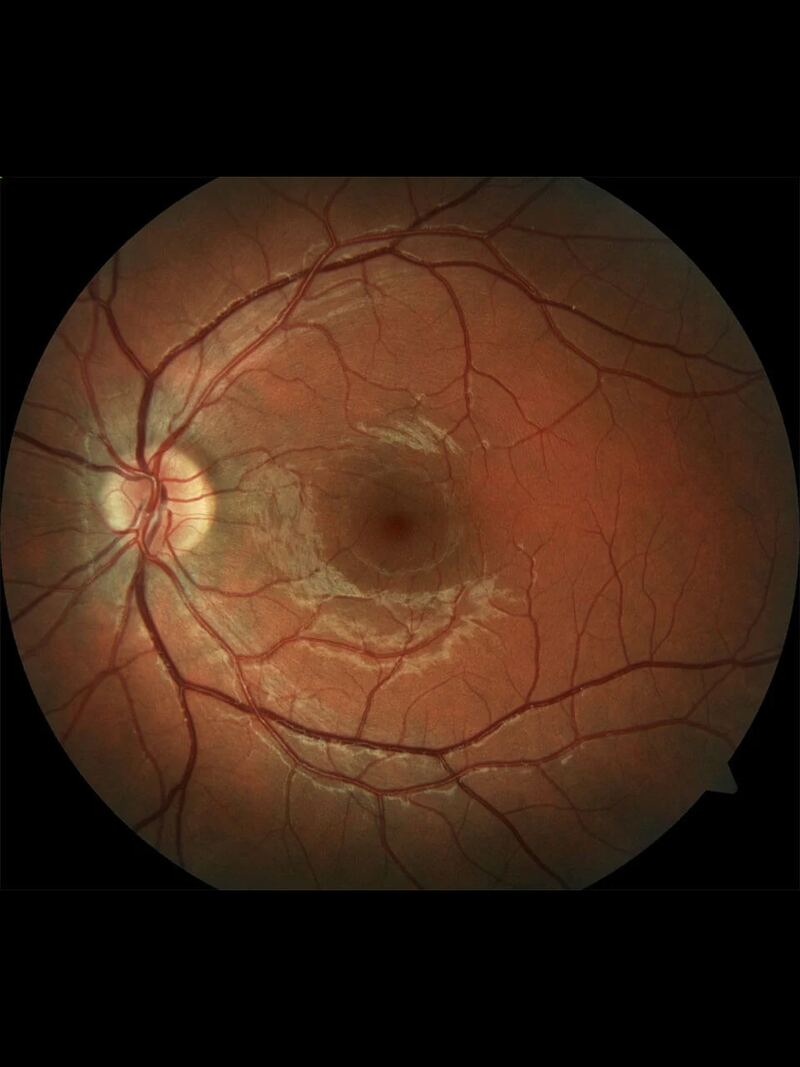 Retinal Exams